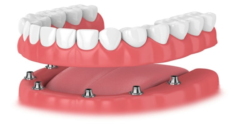 Dentist Dentures Dental Services in Hawkesbury